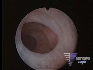 adheremcia intrauterina 016 _1__0004 copia