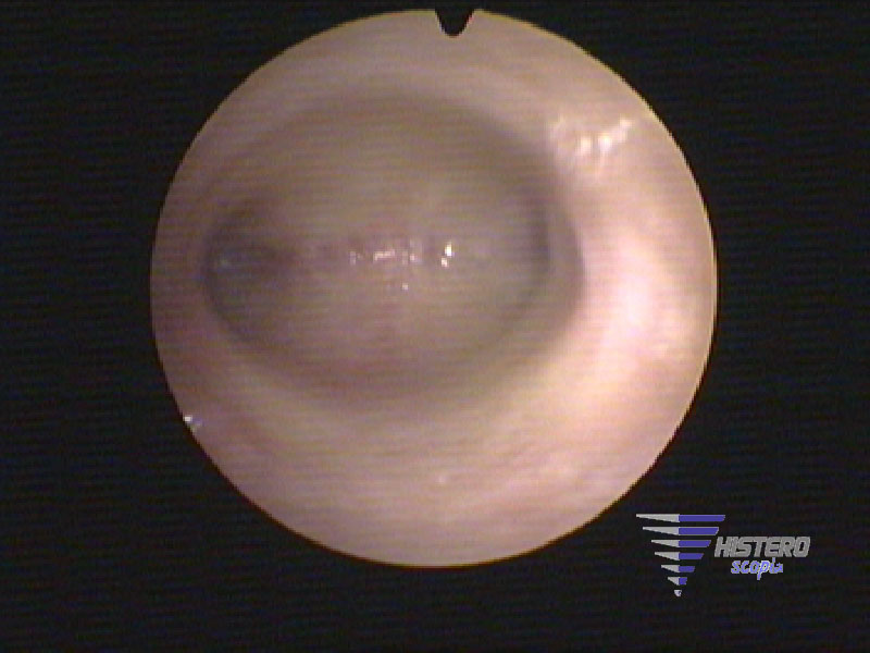 atrofia endometrial 1