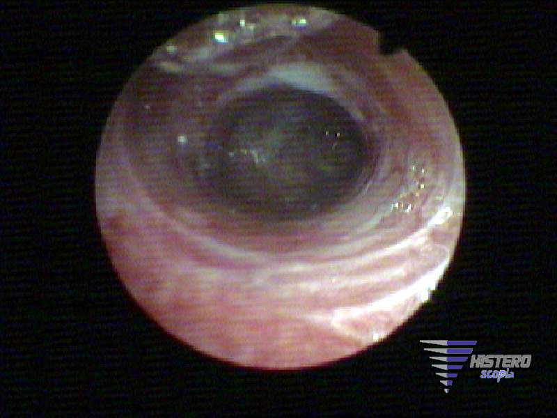 atrofia endometrial 2