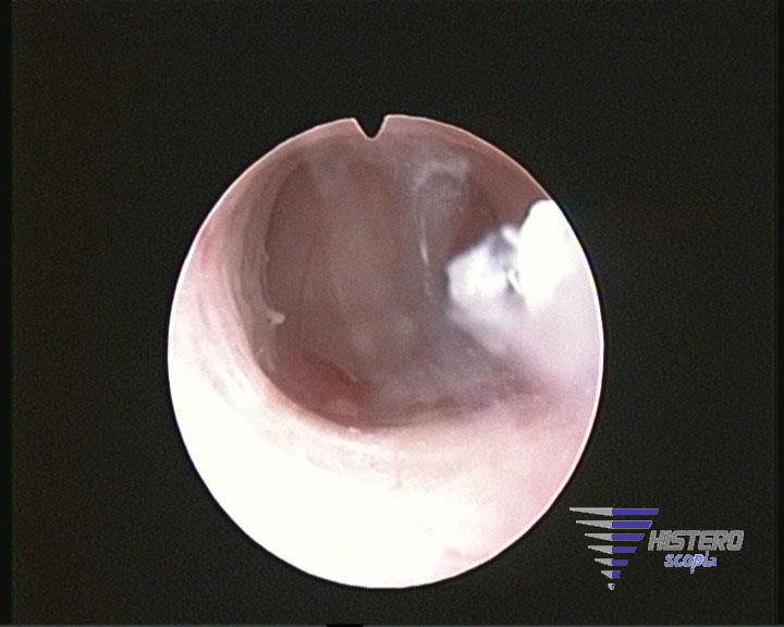 atrofia endometrial 3