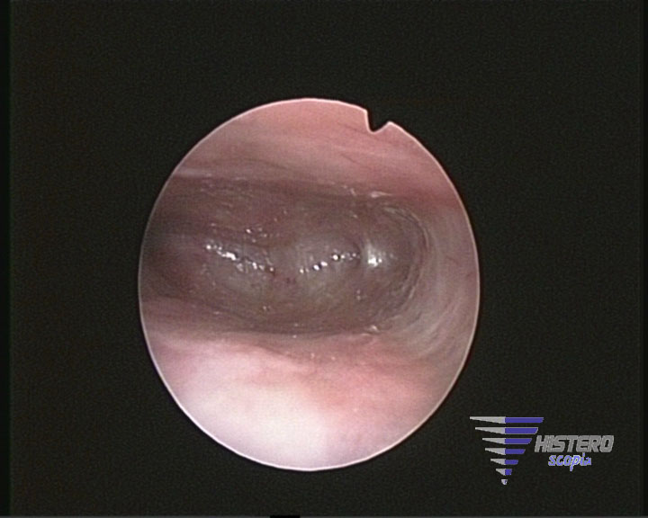 atrofia endometrial 5