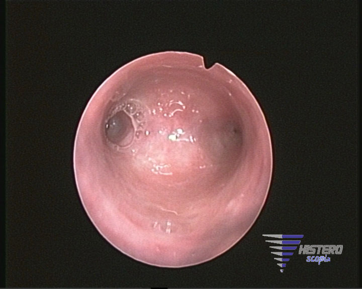 atrofia endometrial 6