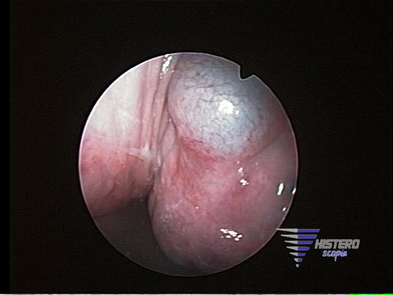 endometriosis tabique 2