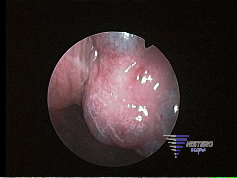 endometriosis tabique 3