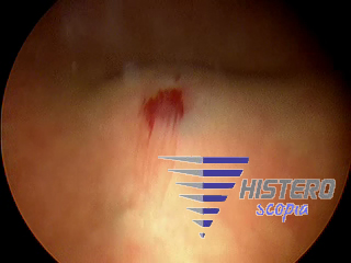 endometriosisvesical4