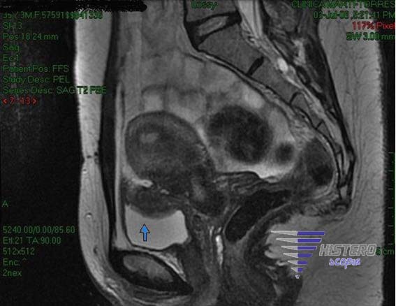 endometriosis vesical