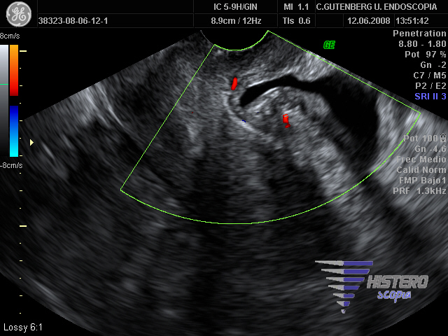 endometriosisvesicaleco1