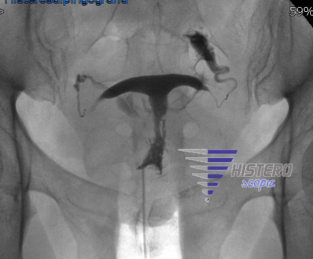 t- shaped uterus utero T