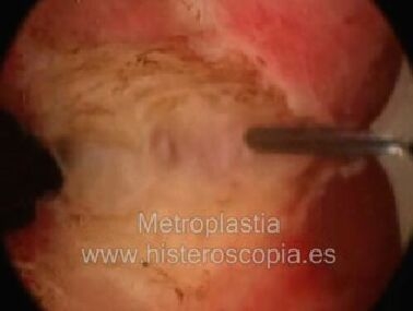 metroplastia video