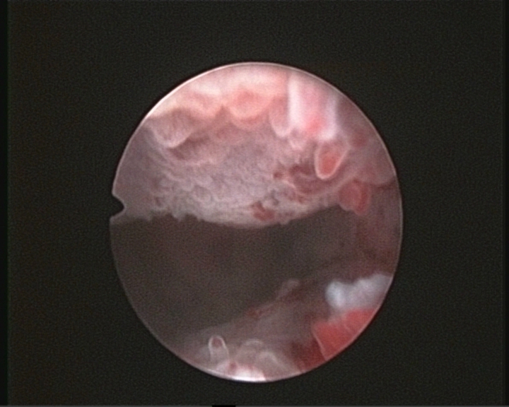 endometritis crónica