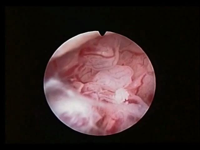 adenocarcinoma6