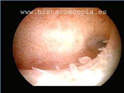 endometritis copia