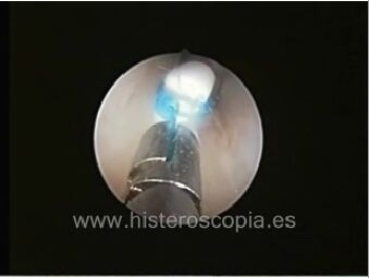 extraccion diu video