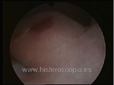 polipo endometrial video