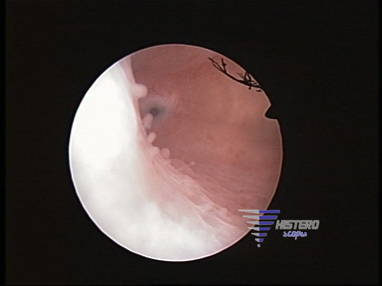 endometritis 2