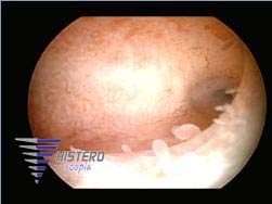 endometritis copia