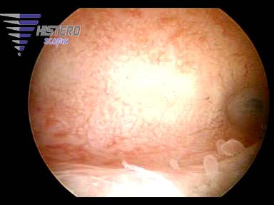 endometritis cron 2