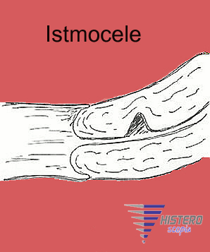 istmocele 2