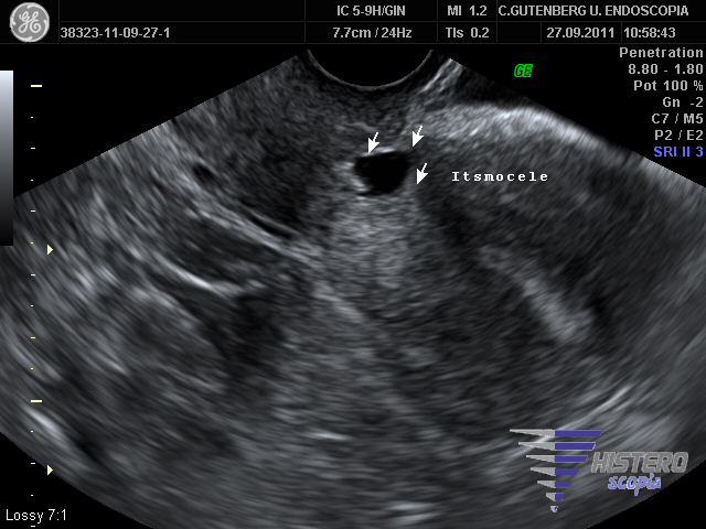 istmocele 4