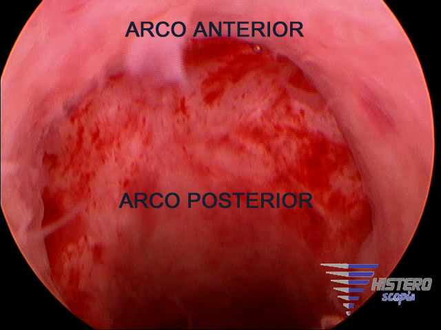 istmocele 5