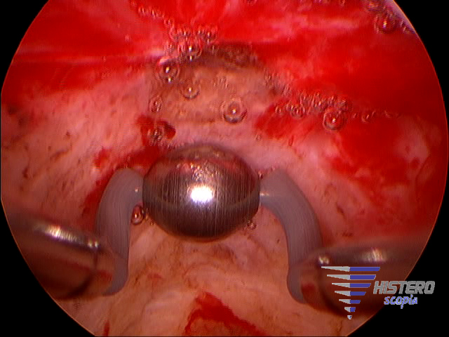 istmocele 6