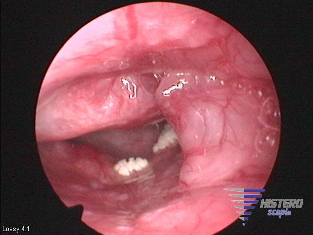 metaplasia osea 1 copia