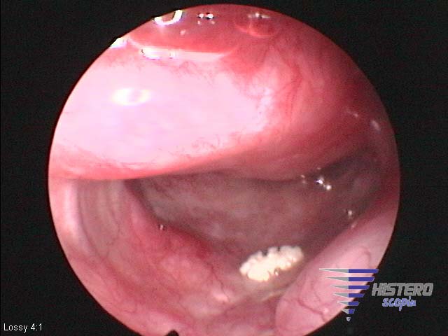 metaplasia osea 2 copia