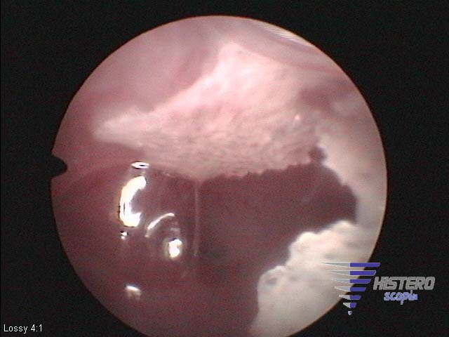 metaplasia osea 4 copia